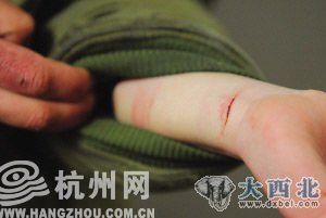 女生展示受伤处 女生展示受伤处