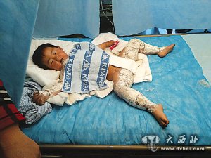 烫伤小女孩图片_小女孩烫伤瘢痕图片_小女孩腿 轻 烫伤