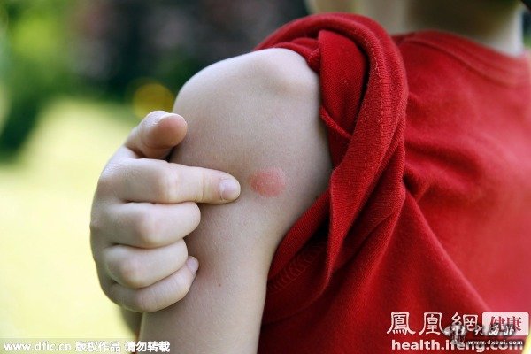 被蚊子咬后这样做快速止痒