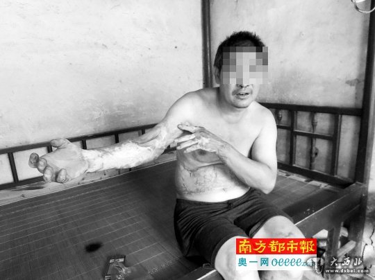 去年6月,为阻止女儿和一男子约会,气头上的李春生忘了关煤气阀门,全身被烧烫伤68%。