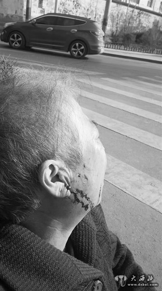 花甲老太带伤哭诉: “儿媳打伤了我”